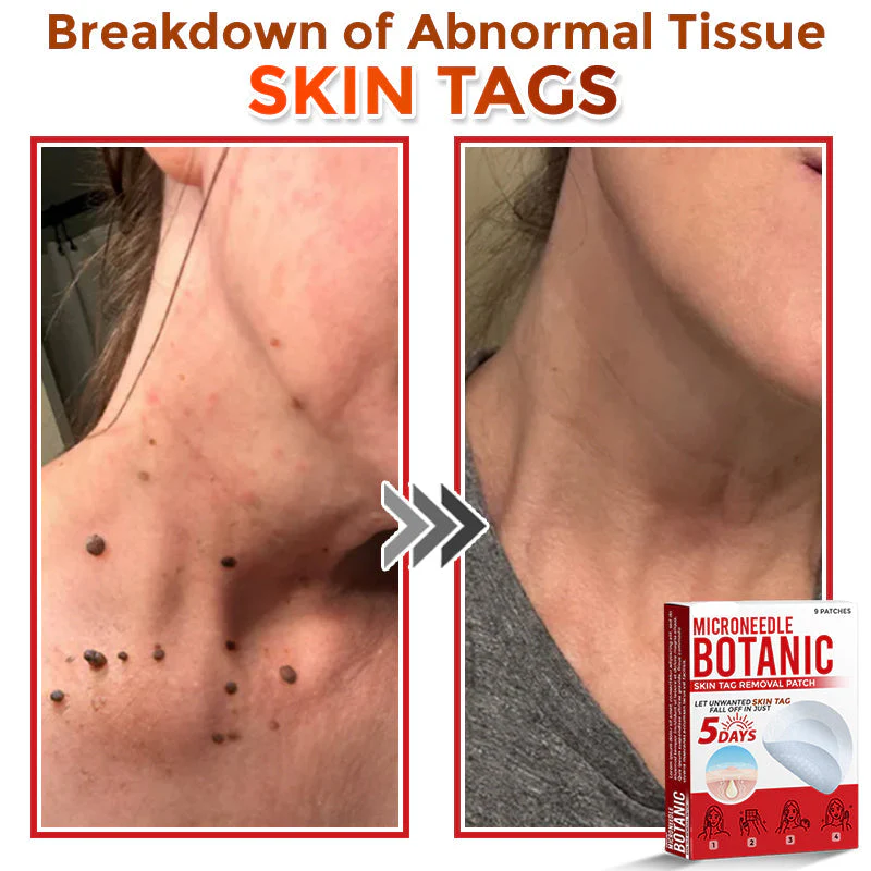 LOVILDS® MicroNeedle Botanic Skin Tag Removal Patch