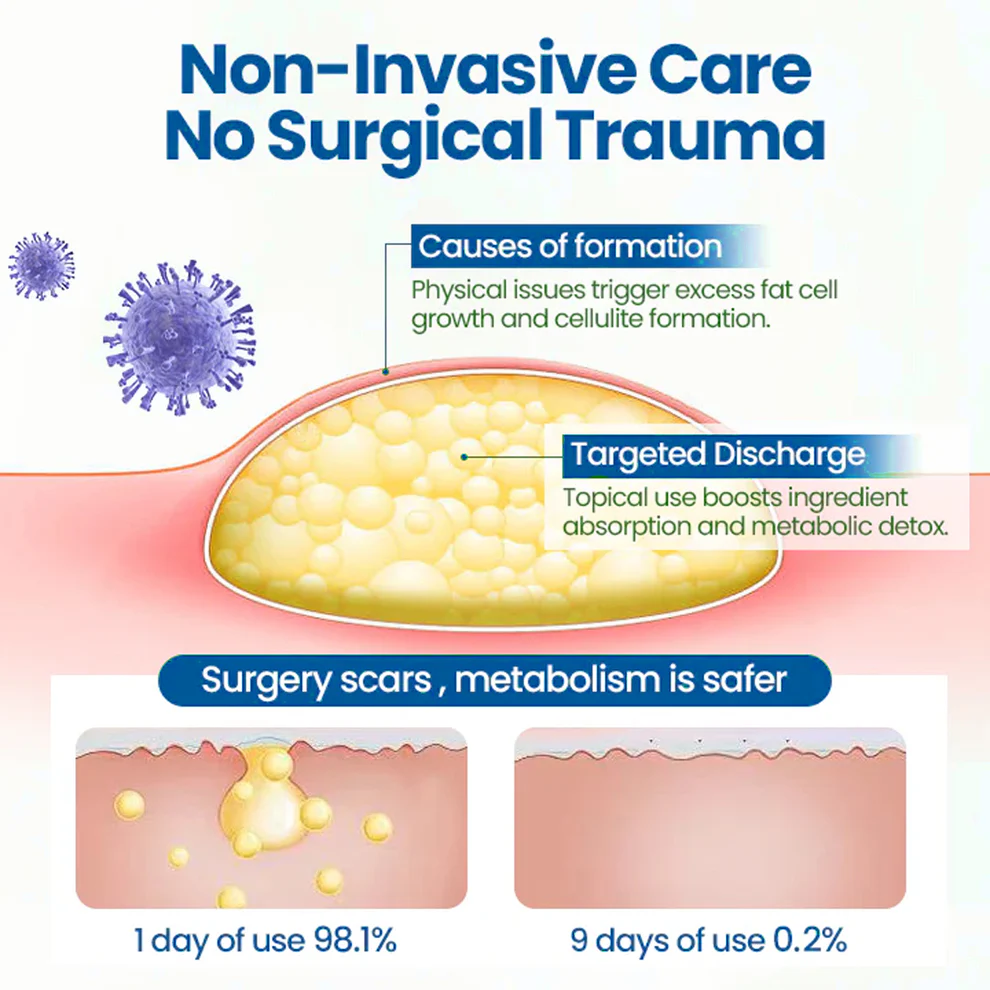 Cvreoz® Lipoma Removal Cream 2 Cvreoz® Lipoma Removal Cream