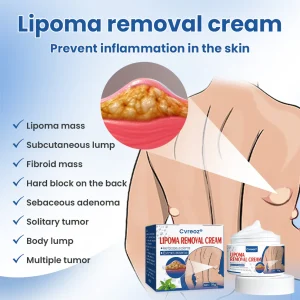 Cvreoz® Lipoma Removal Cream 10 Cvreoz® Lipoma Removal Cream