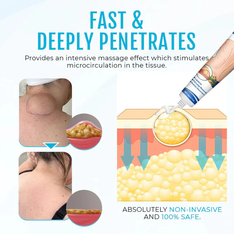 Cvreoz® Lipoma Removal Cream 5 Cvreoz® Lipoma Removal Cream