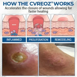 CVREOZ® Diabetes Foot Guard Fast Recovery Spray 14 CVREOZ® Diabetes Foot Guard Fast Recovery Spray