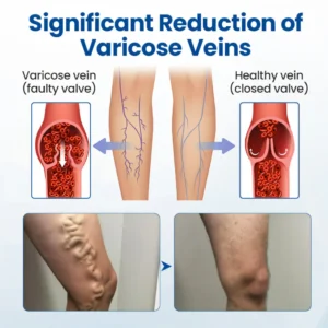 Cvreoz® Varicose Veins Patch 16 Cvreoz® Varicose Veins Patch