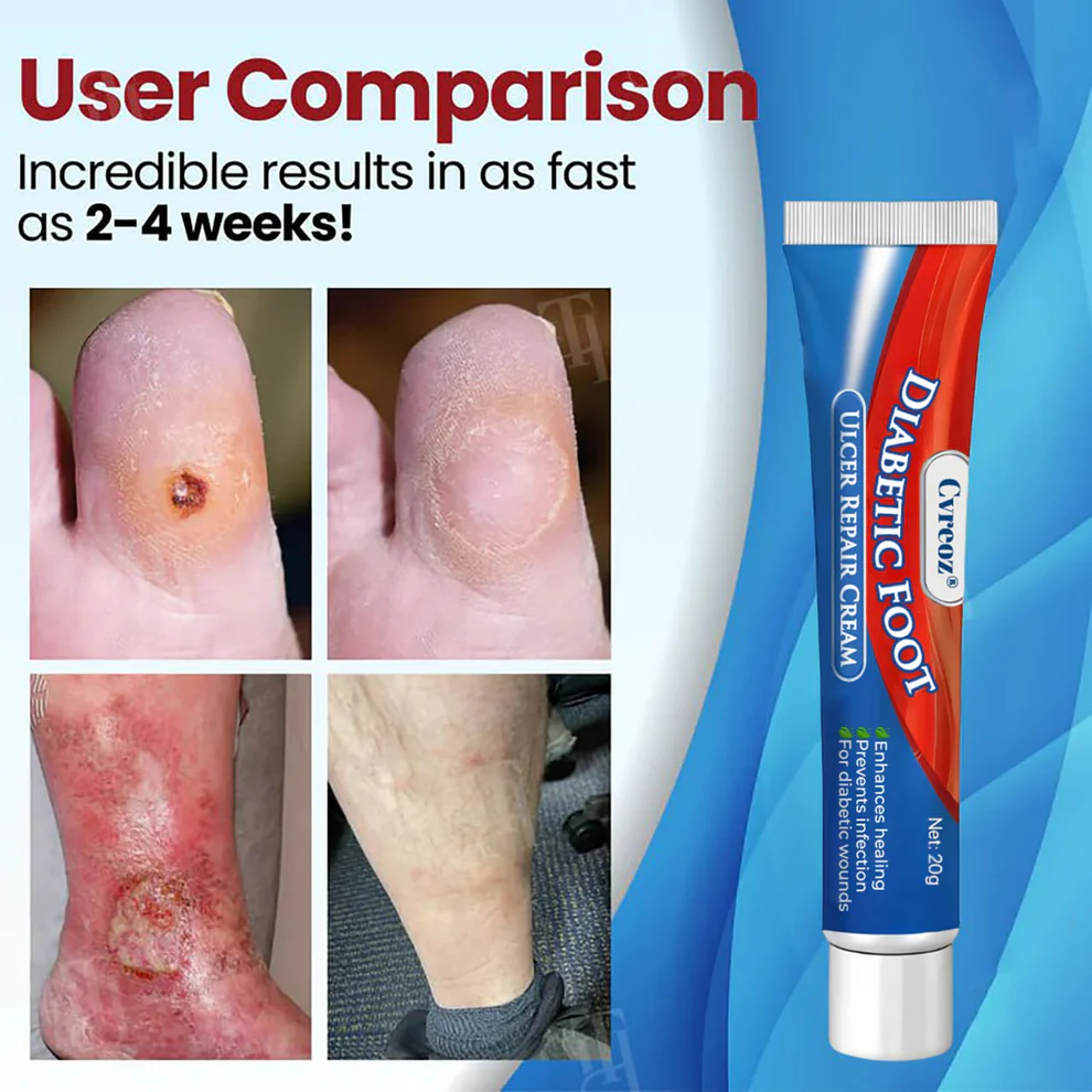 Cvreoz® Diabetic Foot Ulcer Repair Cream 3 Cvreoz® Diabetic Foot Ulcer Repair Cream