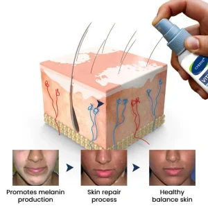 Cvreoz® Vitiligo Treatment Spray 14 Cvreoz® Vitiligo Treatment Spray