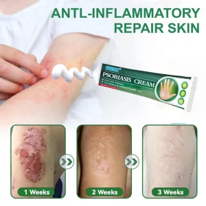 Cvreoz® Knotaway Psoriasis Cream 16 Cvreoz® Knotaway Psoriasis Cream