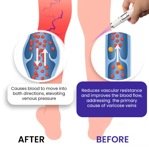 Bikenda® Varicose Vein Photothermal Laser Treatment 3 Bikenda® Varicose Vein Photothermal Laser Treatment
