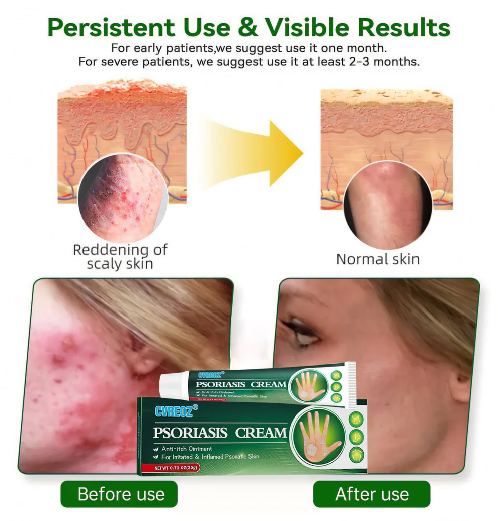 Cvreoz® Knotaway Psoriasis Cream 4 Cvreoz® Knotaway Psoriasis Cream