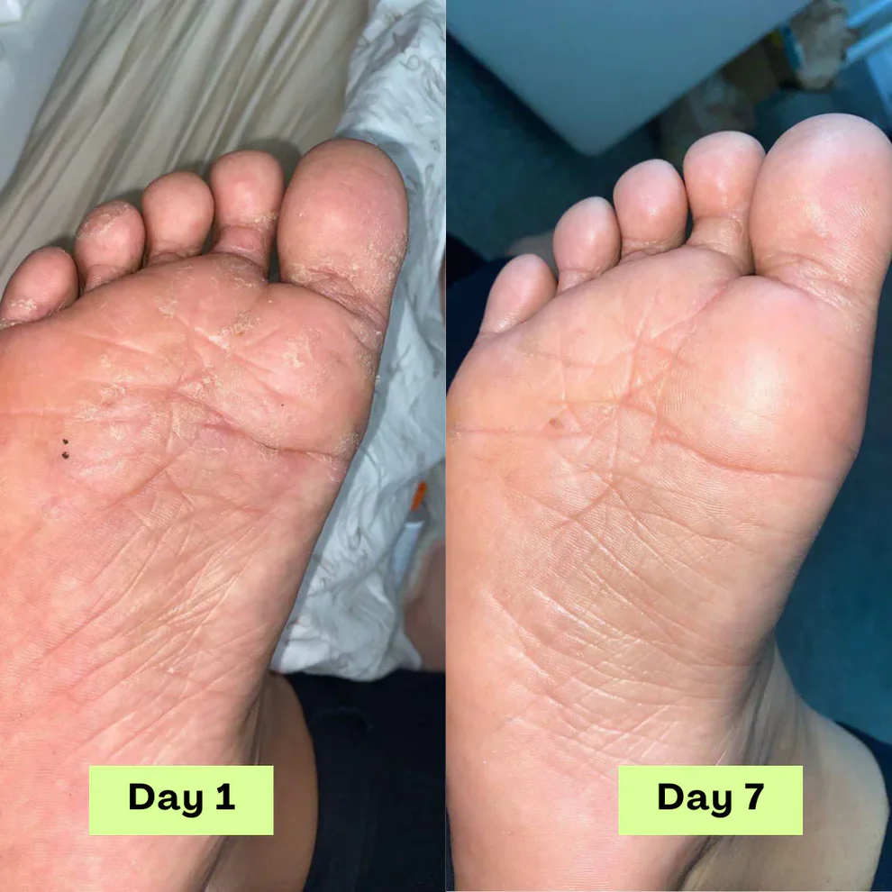 NEGUSY™ Tea Tree Athlete's Foot Defense Soap 7 NEGUSY™ Tea Tree Athlete's Foot Defense Soap