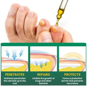 AEXZR® Fungal Nail Treatment 11 AEXZR® Fungal Nail Treatment