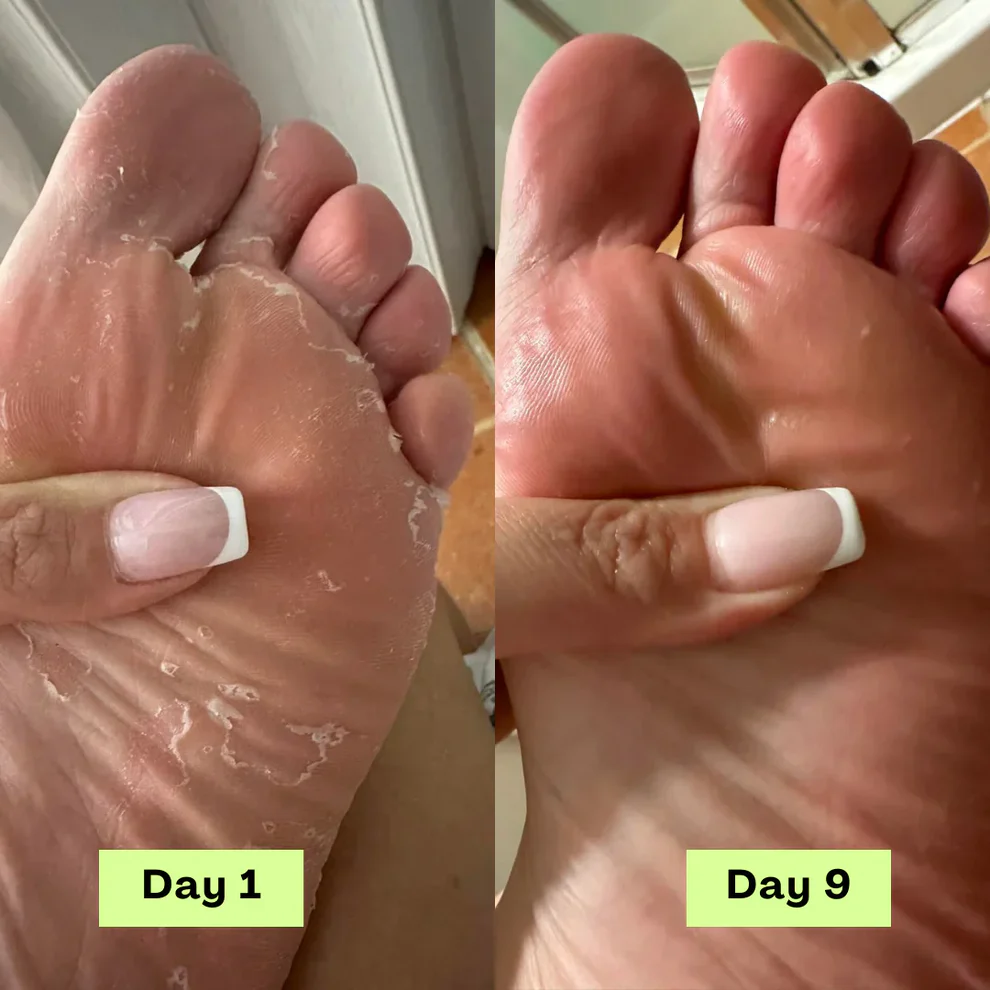 NEGUSY™ Tea Tree Athlete's Foot Defense Soap 6 NEGUSY™ Tea Tree Athlete's Foot Defense Soap