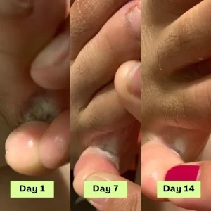 NEGUSY™ Tea Tree Athlete's Foot Defense Soap 11 NEGUSY™ Tea Tree Athlete's Foot Defense Soap