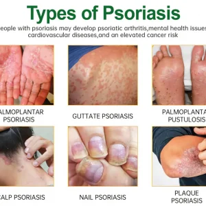 Cvreoz® Knotaway Psoriasis Cream 23 Cvreoz® Knotaway Psoriasis Cream