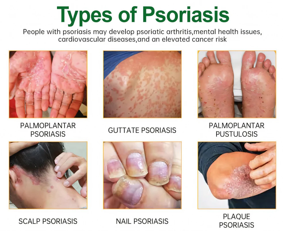 Cvreoz® Knotaway Psoriasis Cream 12 Cvreoz® Knotaway Psoriasis Cream