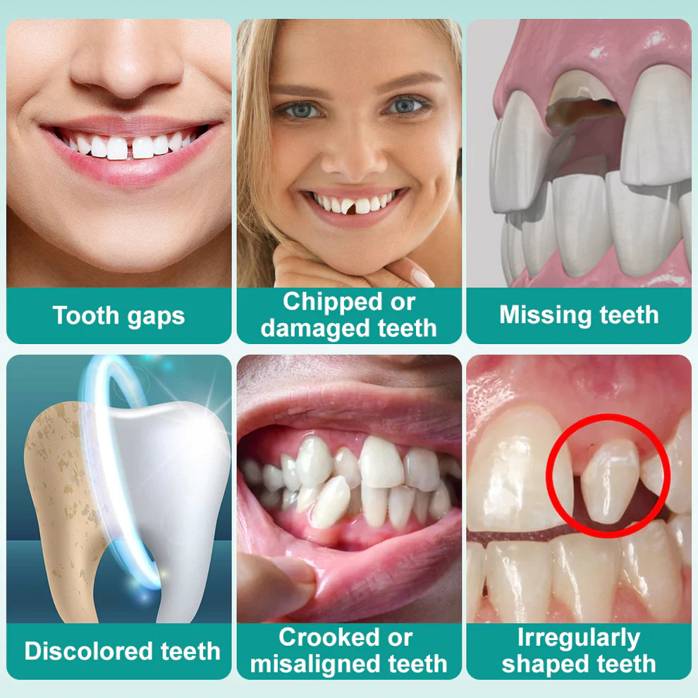 Ourlyard® Instant Stick on Dental Veneers 5 Ourlyard® Instant Stick on Dental Veneers