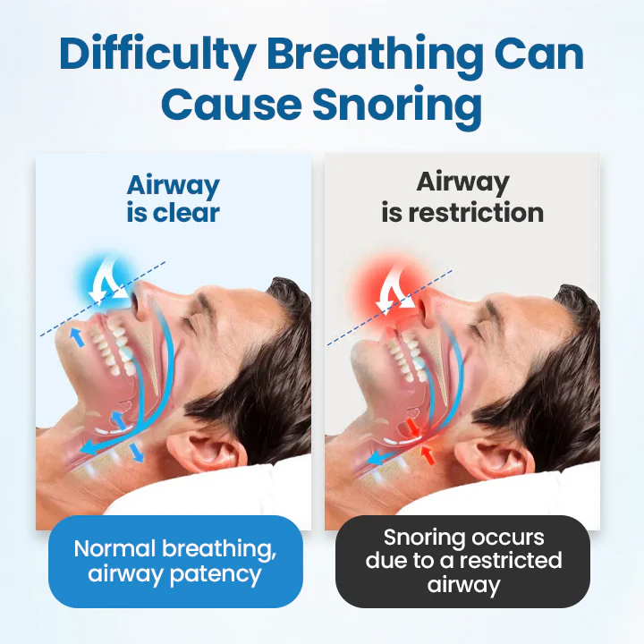 Timilk® SnoreLess Nasal Breather 9 Timilk® SnoreLess Nasal Breather