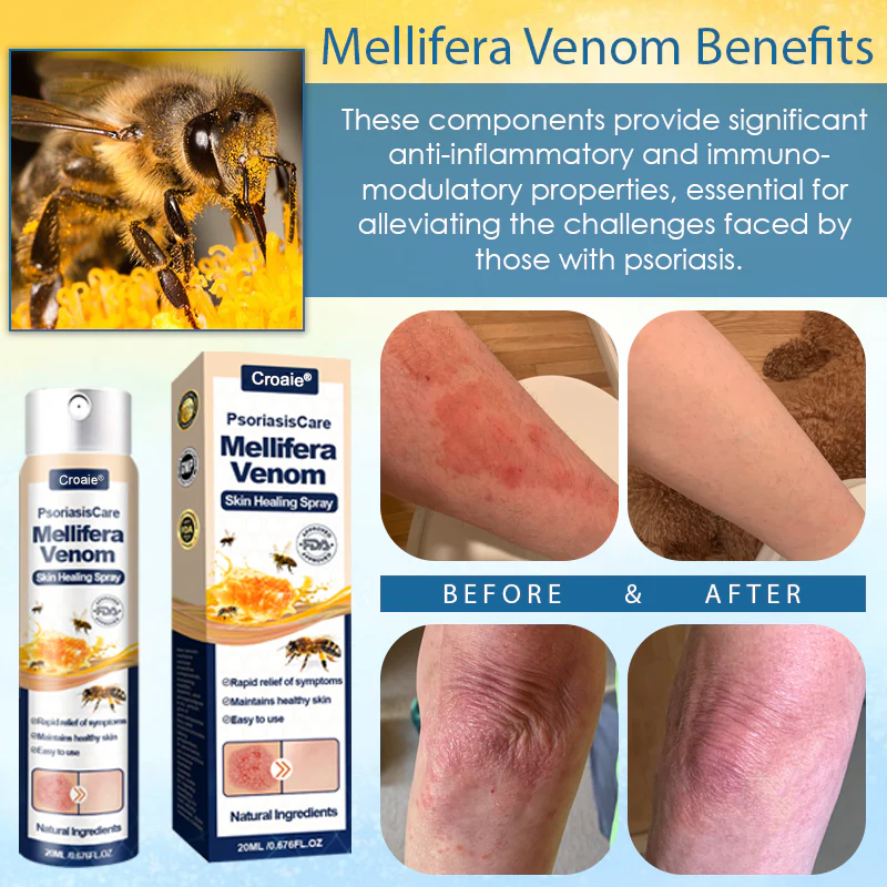 Croaie® PsoriasisCare Mellifera Venom Skin Healing Spray 12 Croaie® PsoriasisCare Mellifera Venom Skin Healing Spray