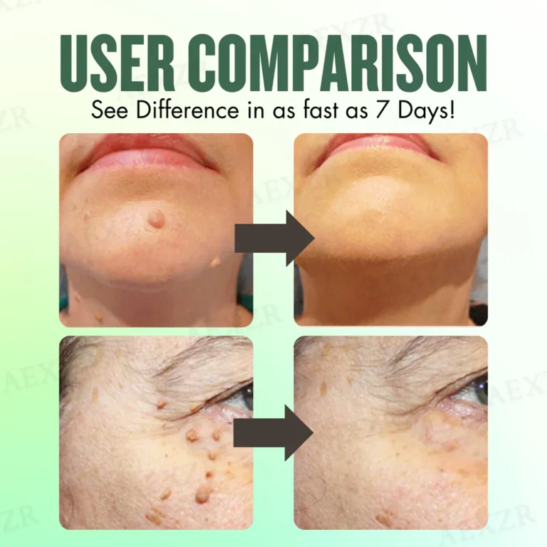 AEXZR® WartsOff Instant Blemish Removal Cream 8 AEXZR® WartsOff Instant Blemish Removal Cream