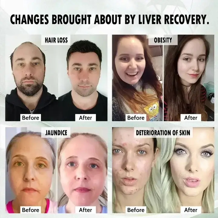 LiverPlus® FGF21 Liver Support Weight Loss Oral Solution 7 LiverPlus® FGF21 Liver Support Weight Loss Oral Solution