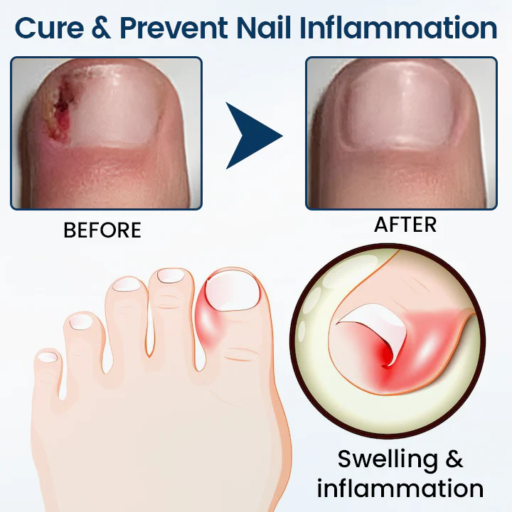 Timilk® OnyxiGuard Fungal Repair Herbal Spray 4 Timilk® OnyxiGuard Fungal Repair Herbal Spray