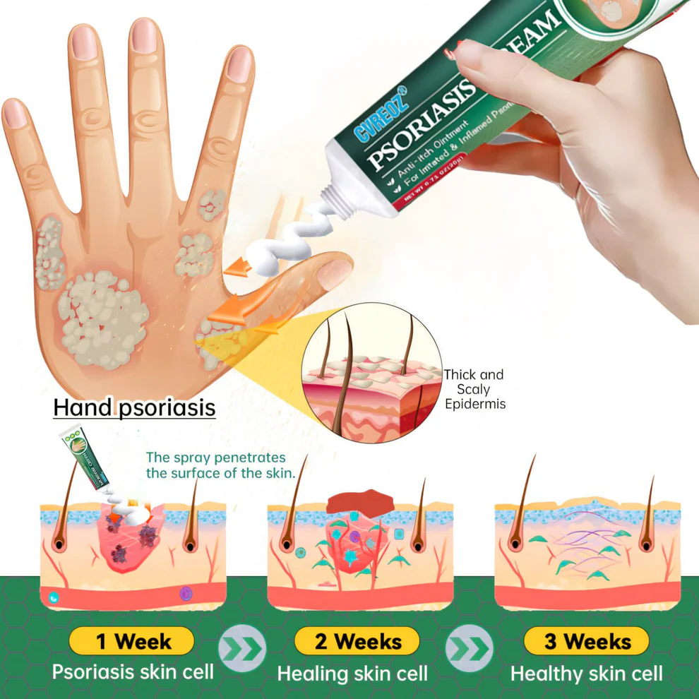 Cvreoz® Knotaway Psoriasis Cream 6 Cvreoz® Knotaway Psoriasis Cream