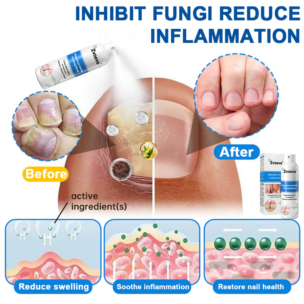 Zvoevo®Magnesium Herbal Psoriasis Spray 5 Zvoevo®Magnesium Herbal Psoriasis Spray