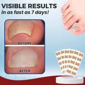 AEXZR® Paronychia Correcting Patch 8 AEXZR® Paronychia Correcting Patch