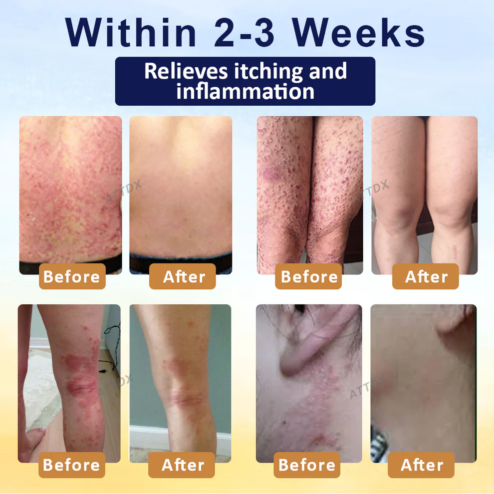 Croaie® PsoriasisCare Mellifera Venom Skin Healing Spray 3 Croaie® PsoriasisCare Mellifera Venom Skin Healing Spray