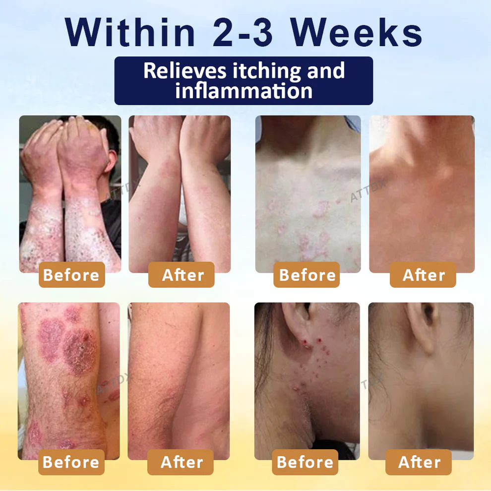 Croaie® PsoriasisCare Mellifera Venom Skin Healing Spray 2 Croaie® PsoriasisCare Mellifera Venom Skin Healing Spray