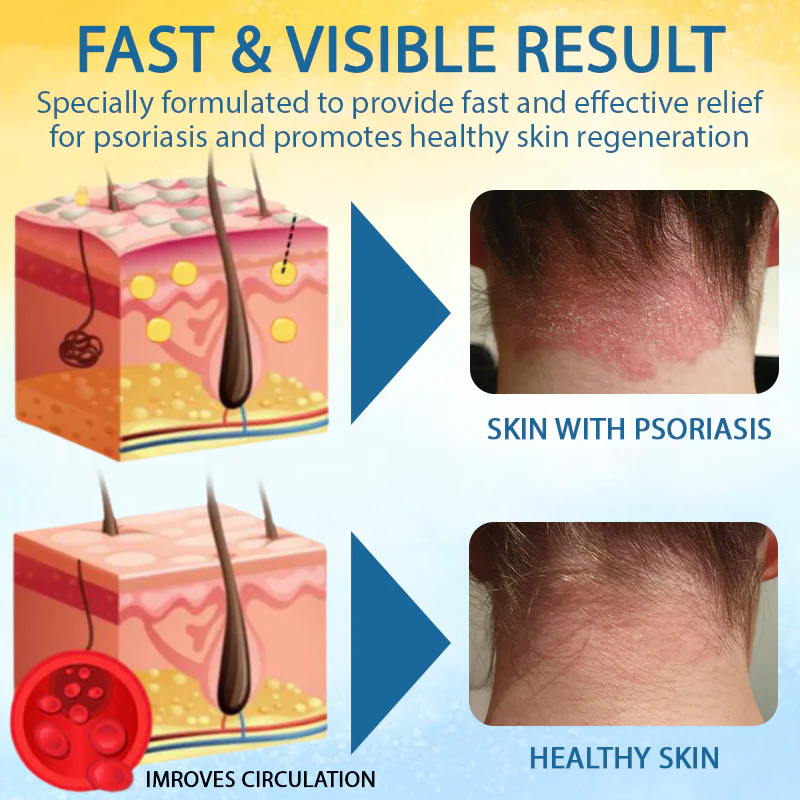 Croaie® PsoriasisCare Mellifera Venom Skin Healing Spray 4 Croaie® PsoriasisCare Mellifera Venom Skin Healing Spray