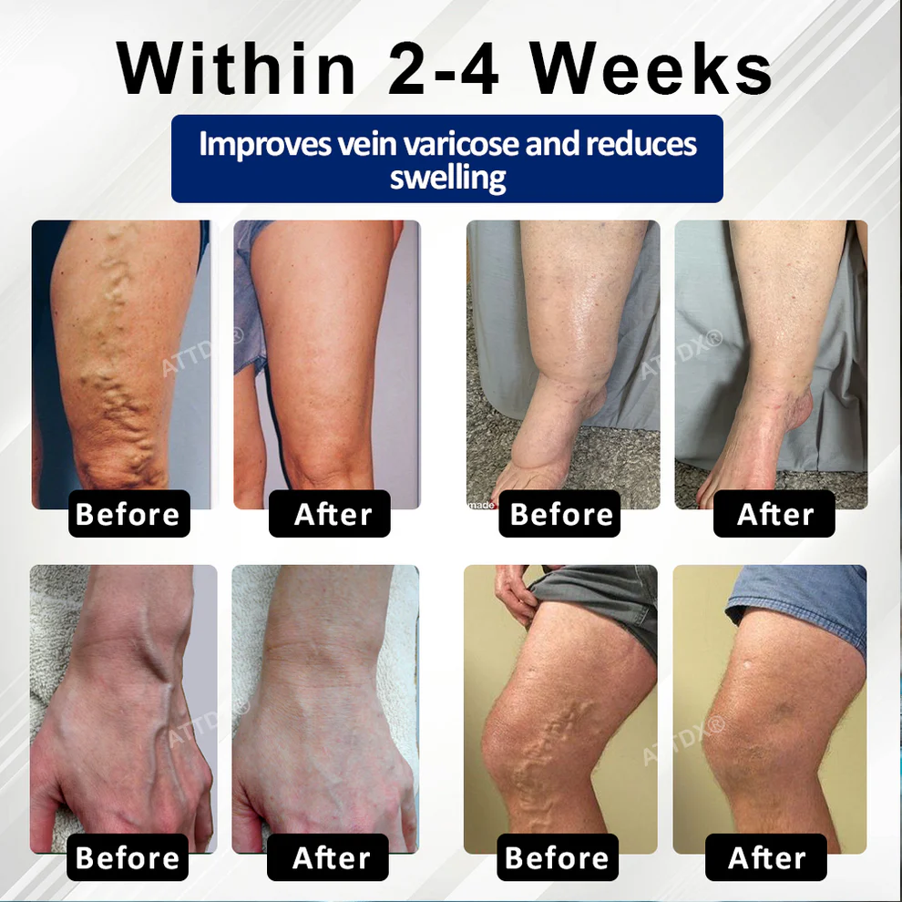 Cvreoz® VeinFocus Microneedle Leg Patch 9 Cvreoz® VeinFocus Microneedle Leg Patch