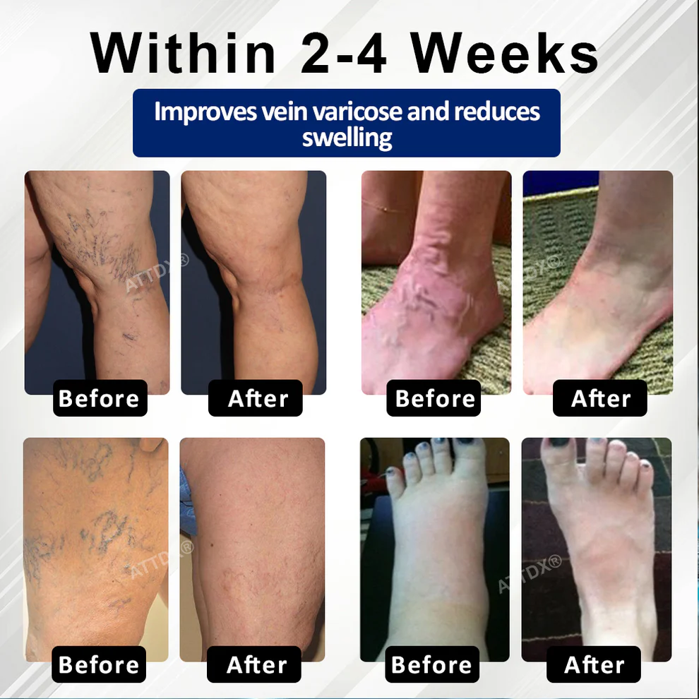 Cvreoz® VeinFocus Microneedle Leg Patch 8 Cvreoz® VeinFocus Microneedle Leg Patch