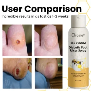 Croaie® Bee Venom Diabetic Foot Ulcer Spray 11 Croaie® Bee Venom Diabetic Foot Ulcer Spray