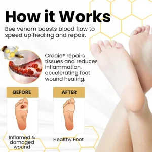 Croaie® Bee Venom Diabetic Foot Ulcer Spray 9 Croaie® Bee Venom Diabetic Foot Ulcer Spray
