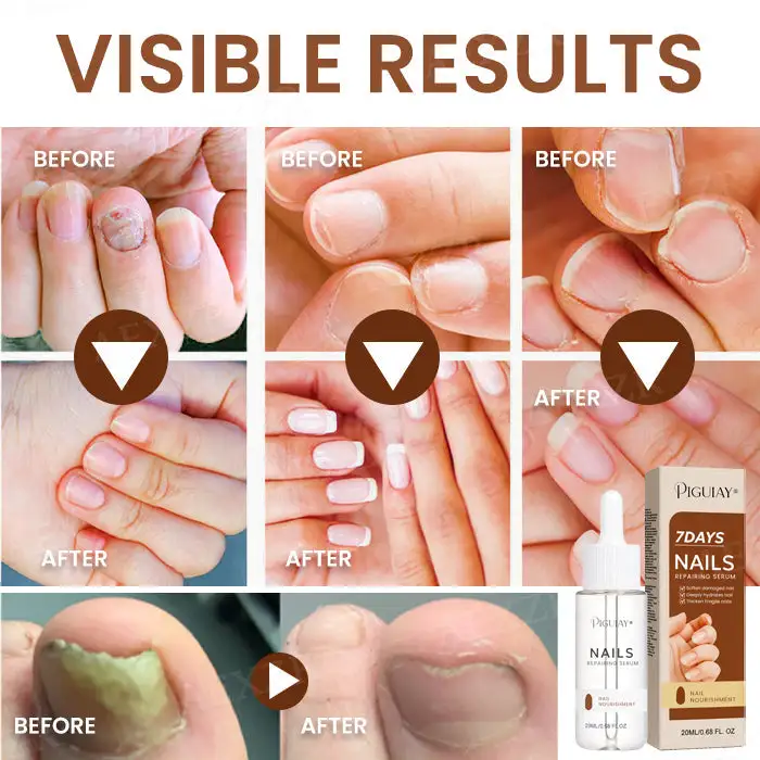 Piguiay® Nails Repairing Serum 5 Piguiay® Nails Repairing Serum