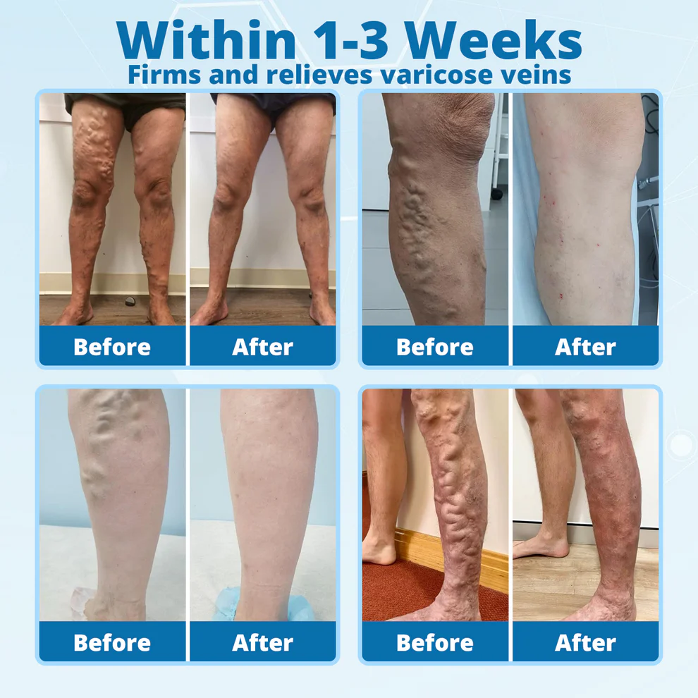 Cvreoz® VeinErase MicroNeedle Repair Patch 7 Cvreoz® VeinErase MicroNeedle Repair Patch