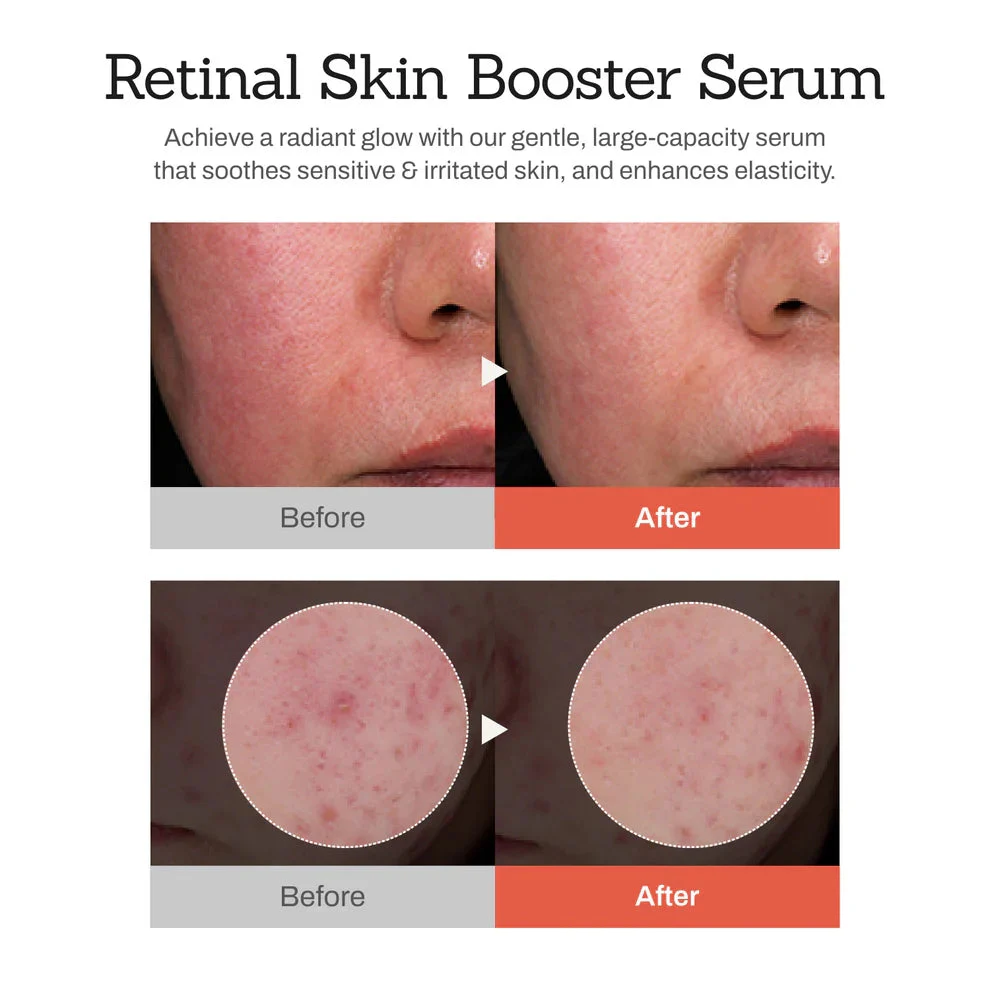 NESLEMY™Retinal Skin Booster Serum 2 NESLEMY™Retinal Skin Booster Serum