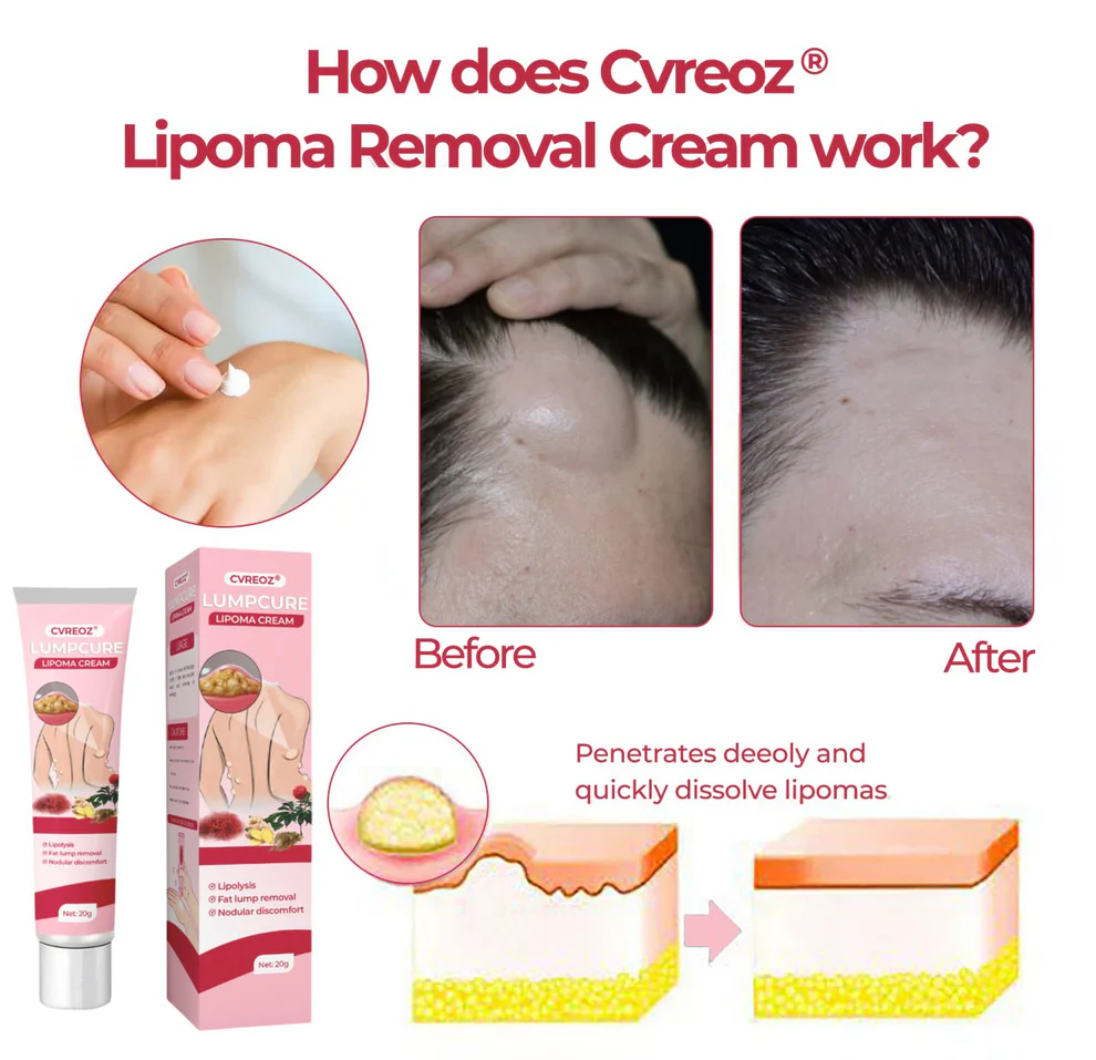 CVREOZ® LumpCure Lipoma Cream 7 CVREOZ® LumpCure Lipoma Cream