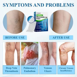 Cvreoz® VeinFocus Microneedle Leg Patch 17 Cvreoz® VeinFocus Microneedle Leg Patch