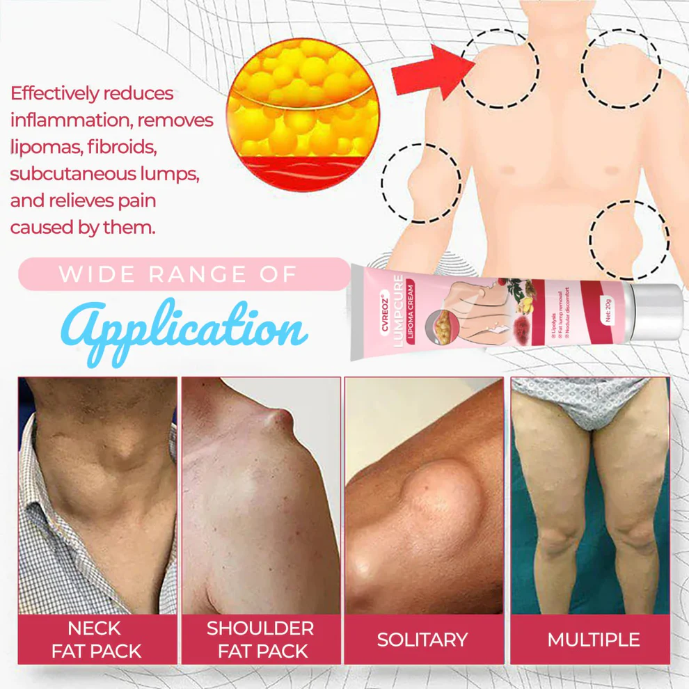 CVREOZ® LumpCure Lipoma Cream 6 CVREOZ® LumpCure Lipoma Cream