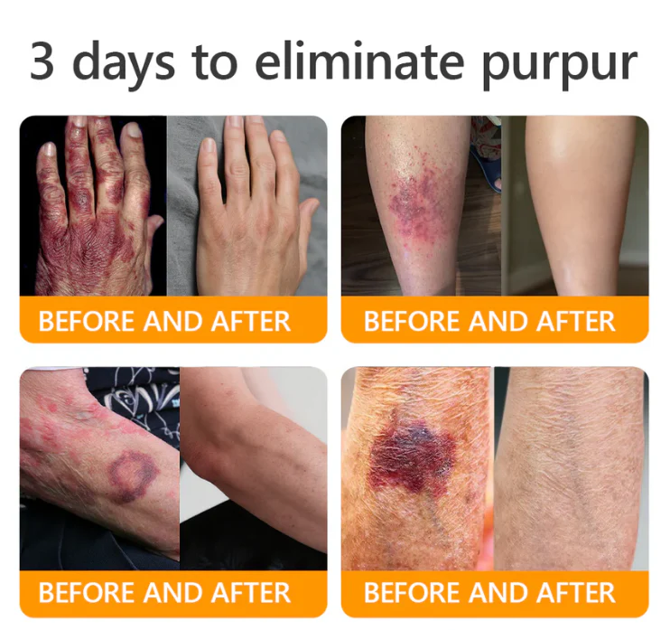 Daasry® Bee Venom Treatment Cream 2 Daasry® Bee Venom Treatment Cream