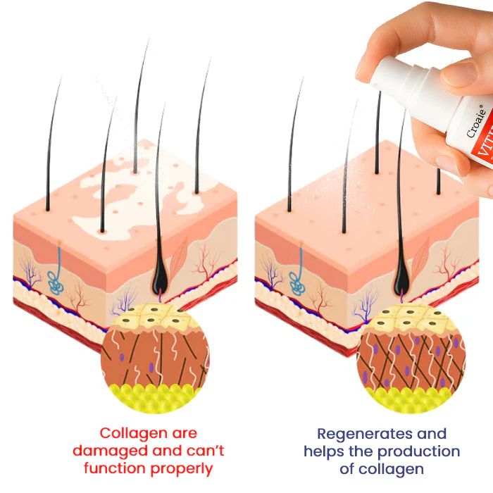 Croaie® Vitiligo Treatment Spray – No allergies 3 Croaie® Vitiligo Treatment Spray – No allergies