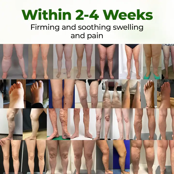 NovaRX® FluidEase Leg Therapy Edema Cream 5 NovaRX® FluidEase Leg Therapy Edema Cream