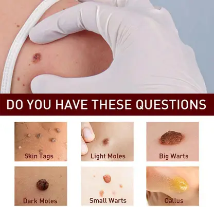 Fivfivgo™ WipeOff Tags & Mole Remover 2 Fivfivgo™ WipeOff Tags & Mole Remover