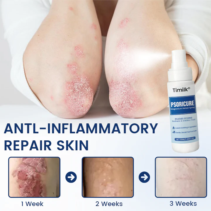 Timilk® PsoriCure Magnesium Herbal Spray 3 Timilk® PsoriCure Magnesium Herbal Spray
