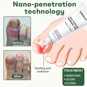 Dobshow® Nail Fungus Renewal Gel 8 Dobshow® Nail Fungus Renewal Gel