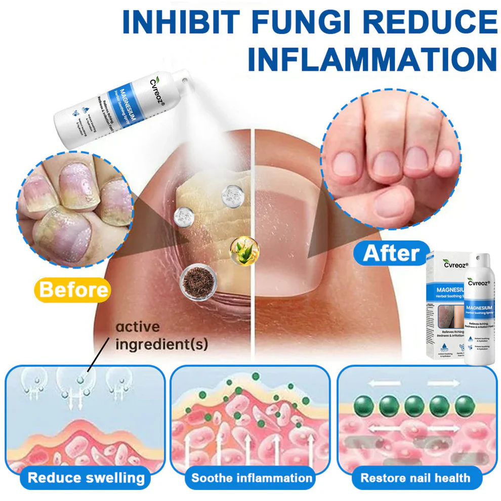 Cvreoz® Magnesium Herbal Psoriasis Spray 5 Cvreoz® Magnesium Herbal Psoriasis Spray