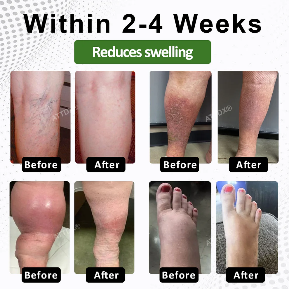 ATTDX® FluidEx Circulation & Drainage Capsules 6 ATTDX® FluidEx Circulation & Drainage Capsules