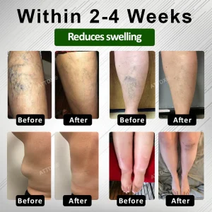 ATTDX® HerbalDrain Edema Comfort Massage Cream 7 ATTDX® HerbalDrain Edema Comfort Massage Cream