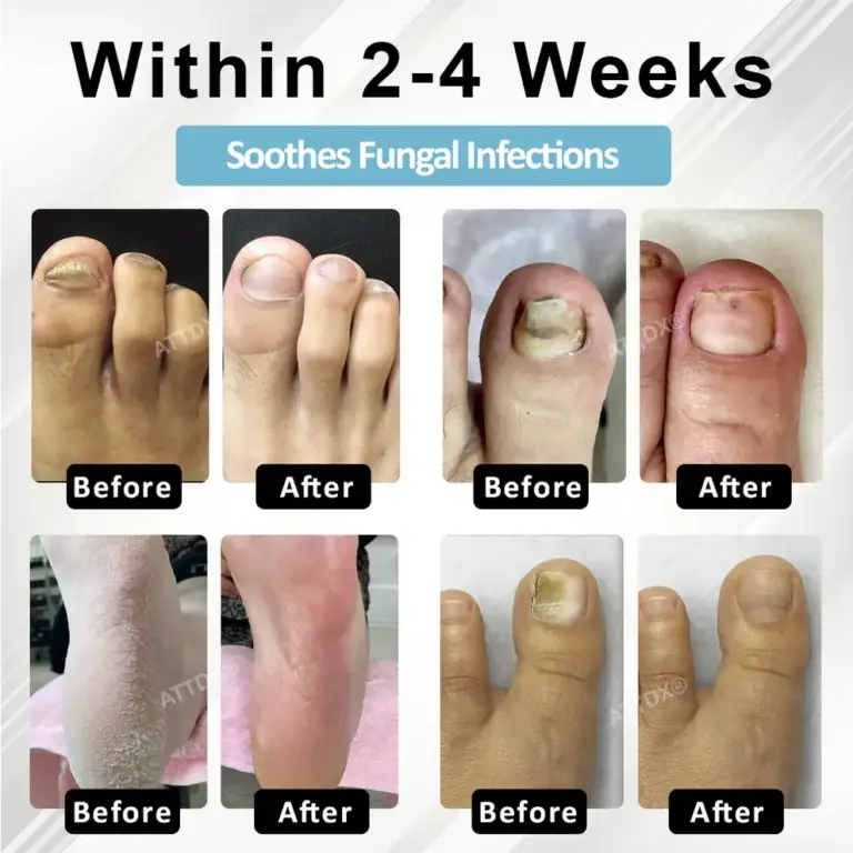 ATTDX® MycoStop Nail Recovery Serum Pen 3 ATTDX® MycoStop Nail Recovery Serum Pen