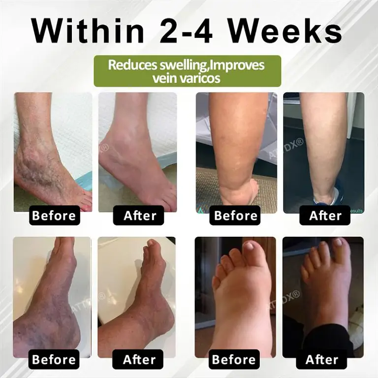 ATTDX® VeinoRoll Therapy Edema Comfort Cream 3 ATTDX® VeinoRoll Therapy Edema Comfort Cream